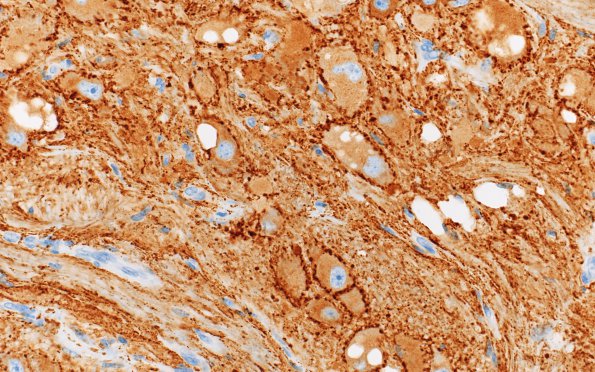 2B6 MB differentiation (Case 1) SYN 40X