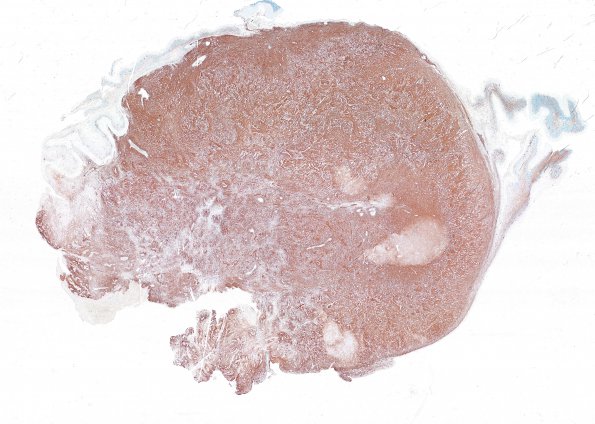 2C1 MB differentiation (Case 1) NF