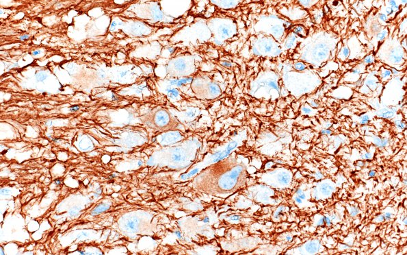 2C3 MB differentiation (Case 1) 40X 3 NF