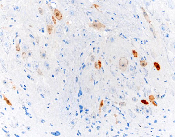 2D MB differentiation (Case 1) NeuN 20X