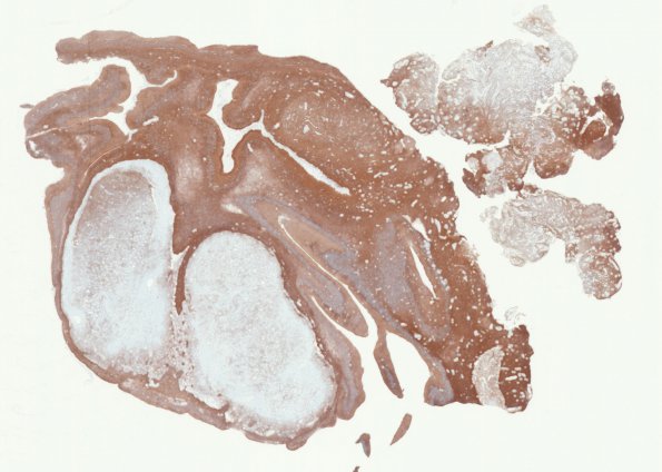 2E1 MB differentiation (Case 1) GFAP WM