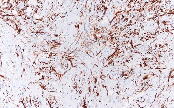 2E3 MB differentiation (Case 1) GFAP 20X 2