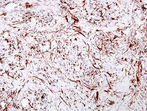 2E4 MB differentiation (Case 1) GFAP 7