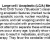 0A Medulloblastoma, LCA - Text