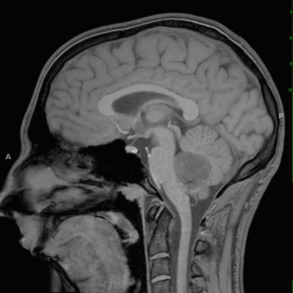 10A Medullo w LCA (Case 10)  T1 1 - Copy