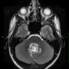 10A2 Medullo w LCA (Case 10)  T2 1 - Copy