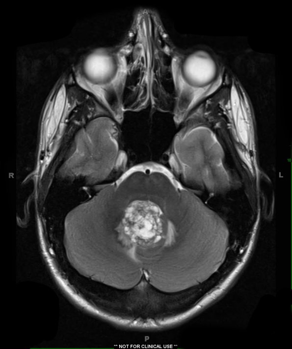 10A2 Medullo w LCA (Case 10)  T2 1 - Copy