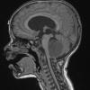 11A1 Medulloblastoma, large cell (Case 11) T1 2 - Copy