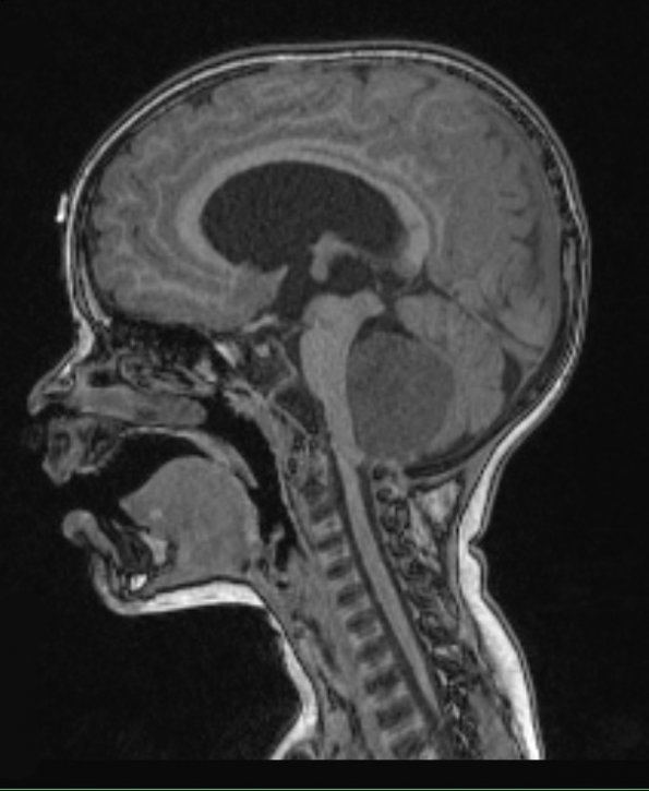 11A1 Medulloblastoma, large cell (Case 11) T1 2 - Copy