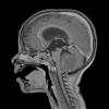 11A2 Medulloblastoma, large cell (Case 11) T1W 2 - Copy