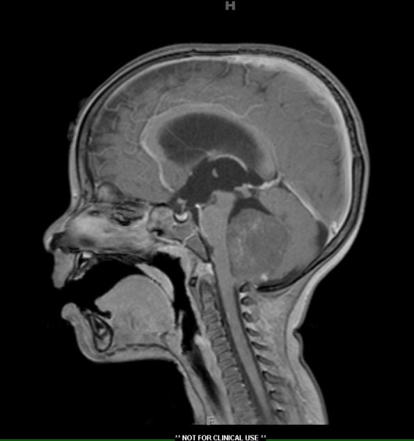 11A2 Medulloblastoma, large cell (Case 11) T1W 2 - Copy