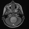 11A3 Medulloblastoma, large cell (Case 11) T2 1 - Copy