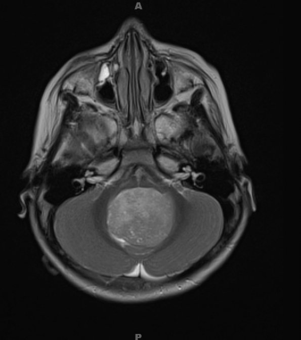 11A3 Medulloblastoma, large cell (Case 11) T2 1 - Copy