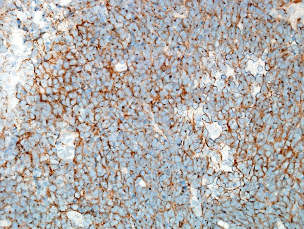  11C1 Medulloblastoma, large cell type (Case 11) SYN 1.jpg