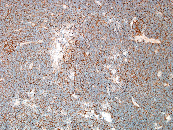 11C1 Medulloblastoma, large cell type (Case 11) SYN 2.jpg