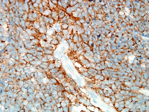 11C2 Medulloblastoma, large cell type (Case 11) SYN 4.jpg