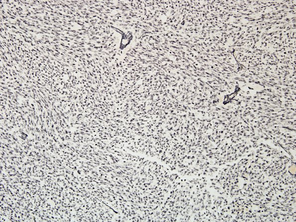 11F Medulloblastoma, large cell type (Case 11) Retic.jpg