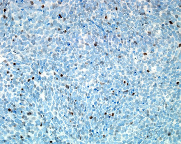 11H Medulloblastoma, large cell type (Case 11) p53 1.jpg