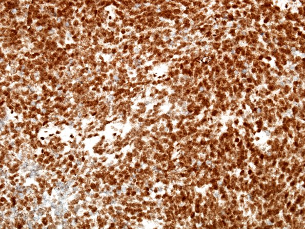 11I Medulloblastoma, large cell type (Case 11) INI1 1.jpg