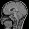 12A1 Medulloblastoma, LCA (Case 12) T1 1 - Copy