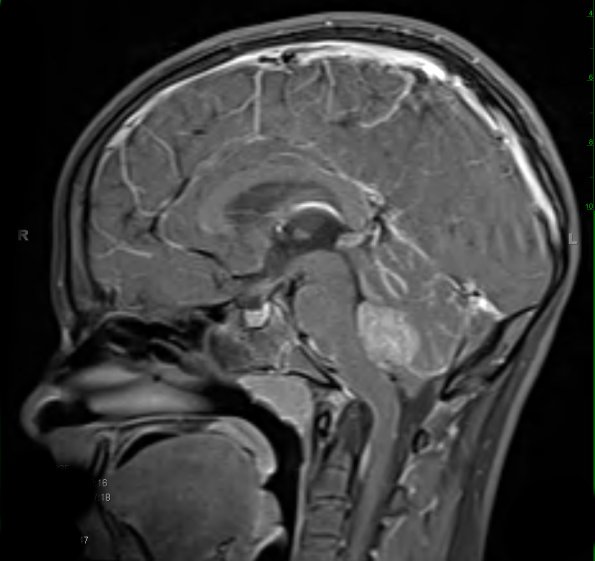 12A2 Medulloblastoma, large cell-anaplastic (Case 12) T1 W 1 - Copy