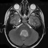 12A3 Medulloblastoma, large cell-anaplastic (Case 12) T2 1 - Copy