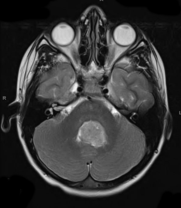 12A3 Medulloblastoma, large cell-anaplastic (Case 12) T2 1 - Copy