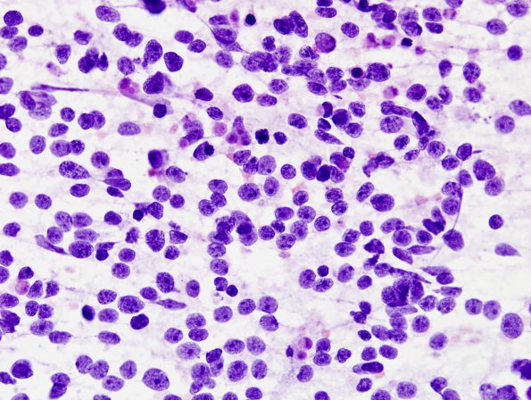 12B1 Medulloblastoma, LCA (Case 12) H&E Sm 1