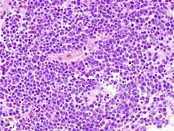 12B2 Medulloblastoma, LCA (Case 12) H&E 4