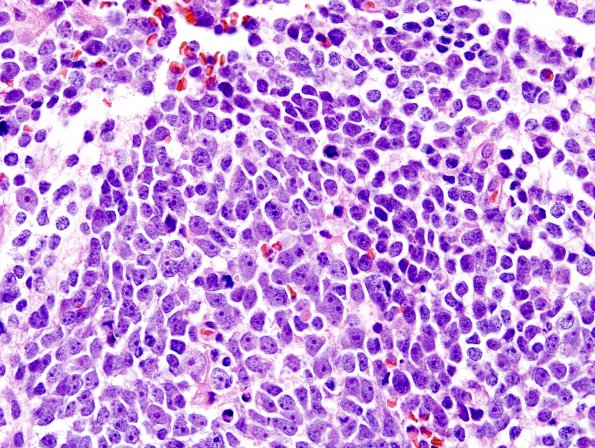 12B3 Medulloblastoma, large cell-anaplastic (Case 12) H&E 2