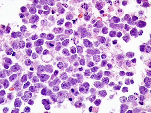 12B4 Medulloblastoma, large cell-anaplastic (Case 12) H&E 10