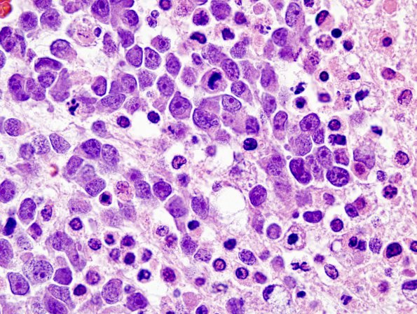 12B5 Medulloblastoma, large cell-anaplastic (Case 12) H&E 9