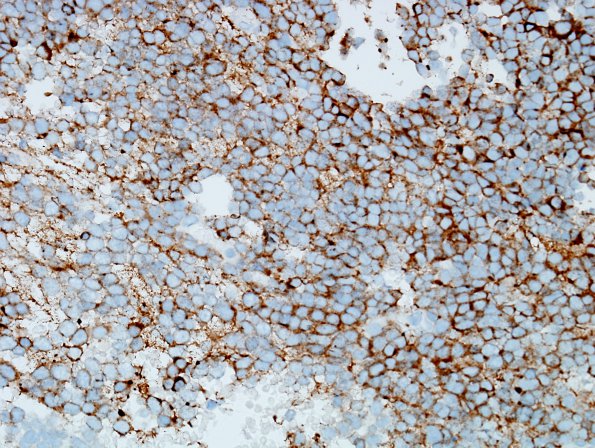 12C Medulloblastoma, LCA (Case 12) SYN