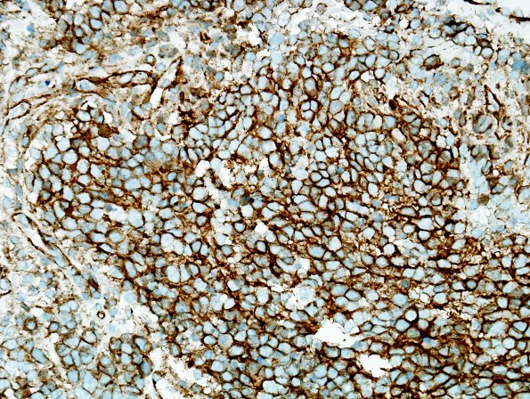 12D Medulloblastoma, LCA (Case 12) B-catenin 1