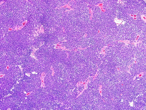 13A1 Medulloblastoma, LCA (Case 13) H&E 10X