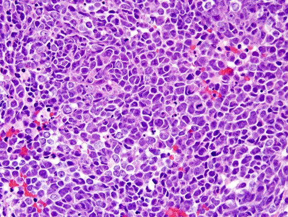 13A2 Medulloblastoma, LCA (Case 13) H&E 2.jpg