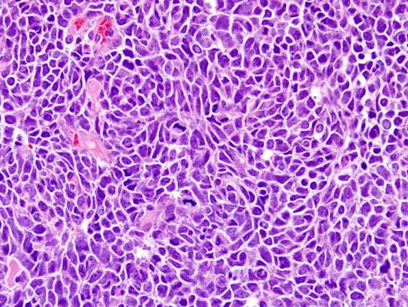 13A3 Medulloblastoma, LCA (Case 13) H&E 100X 11.jpg