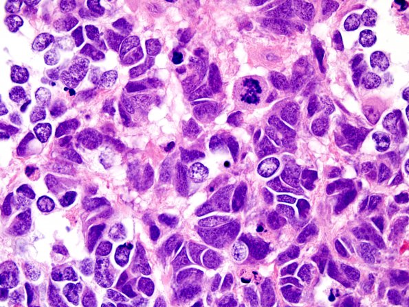 13A4 Medulloblastoma, LCA (Case 13) H&E 100X 13.jpg