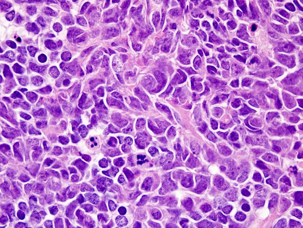 13A5 Medulloblastoma, LCA (Case 13) H&E 100X 15