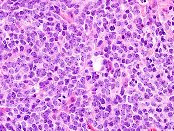 14A2 Medulloblastoma, large cell (Case 14) H&E 1