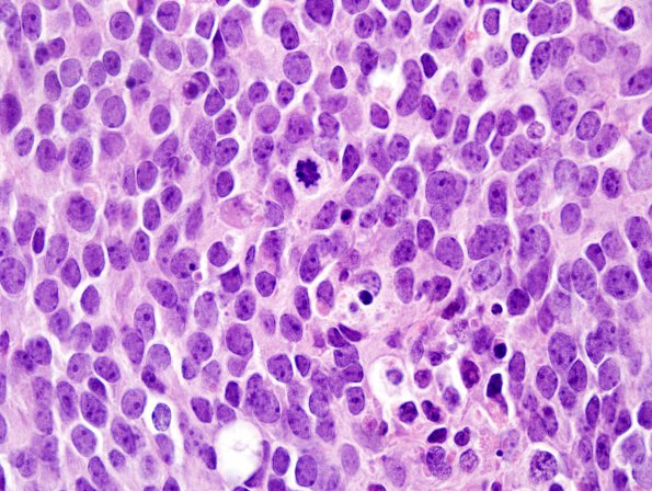 14A3 Medulloblastoma (Case 14) 100X 2