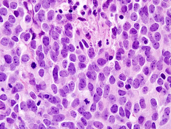 14A4 Medulloblastoma (Case 14) 100X 1