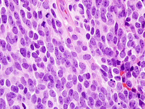 14A5 Medulloblastoma (Case 14) 100X 3