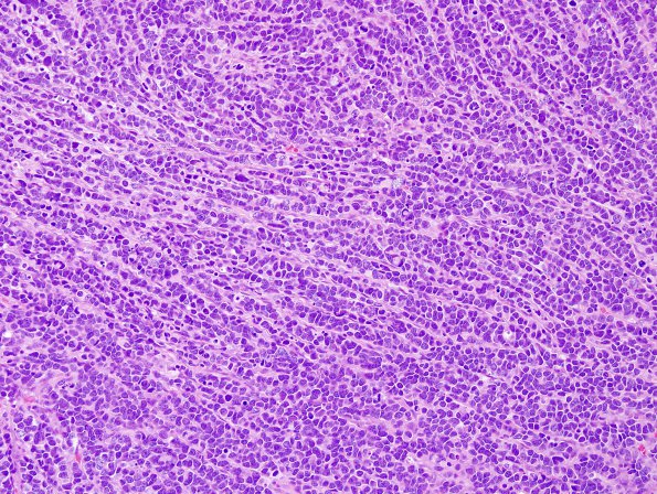 15A1 Medulloblastoma, LCA (Case 15) H&E 1.jpg