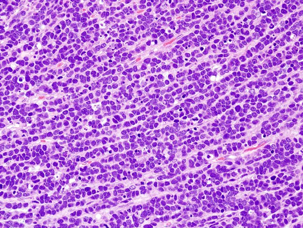  15A2 Medulloblastoma, LCA (Case 15) H&E 2.jpg