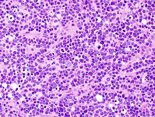  15A3 Medulloblastoma, LCA (Case 15) H&E 3.jpg