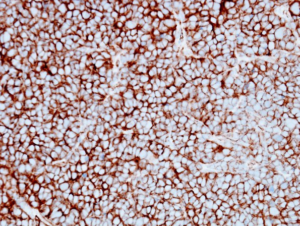  15B Medulloblastoma, LCA (Case 15) b-catenin.jpg