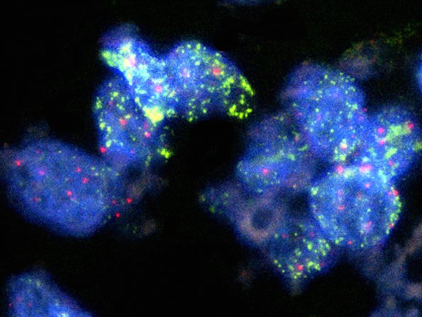 1E MB LCA (Case 1) N-myc amplification