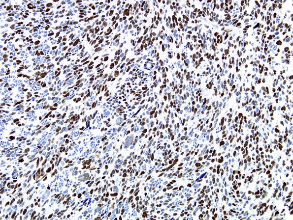 1G Medulloblastoma, LCA (Case 1) p53