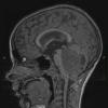 2A1 Medulloblastoma LCA (Case 2) MRI 1 - Copy